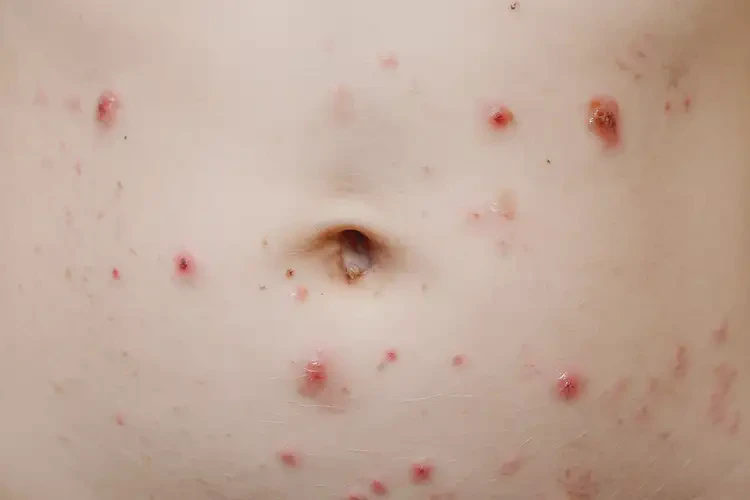 小學(xué)生肚子上經(jīng)常長(zhǎng)濕疹能不能徹底自愈(圖4)