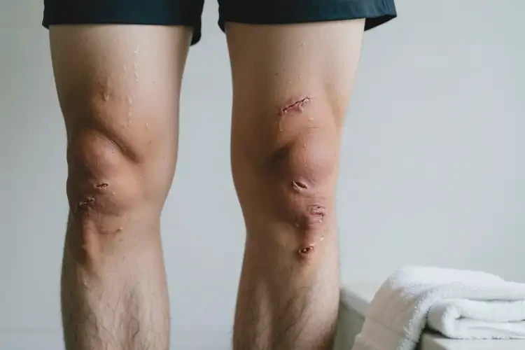 男性大腿出湿疹可以治好吗(图2)