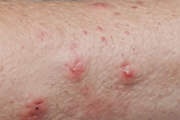 老年人手臂偶爾起濕疹可以治好嗎(圖4)