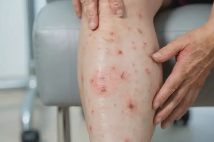 女人小腿上容易起濕疹可不可以根治(圖4)