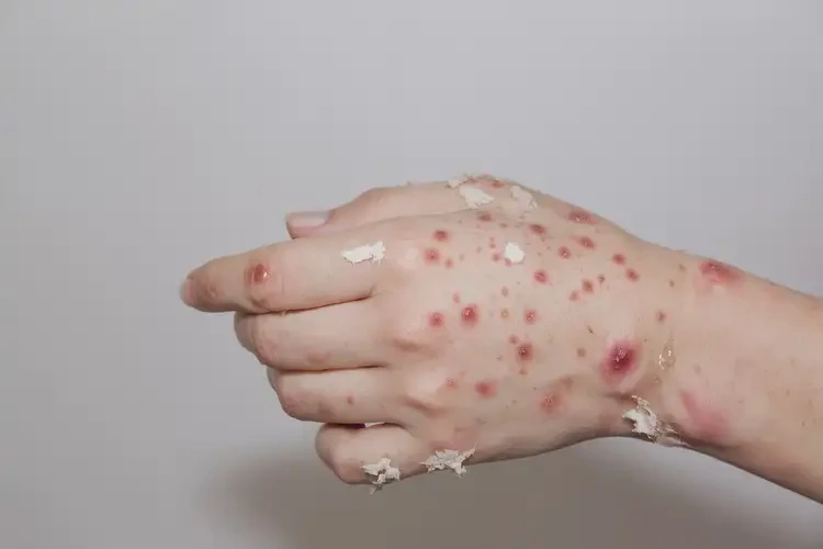 中學生手上容易長濕疹能靠自己自愈嗎(圖3)