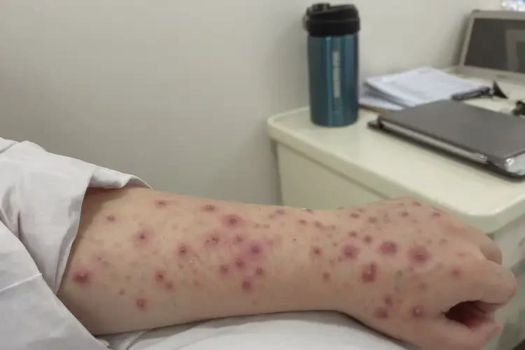 產(chǎn)婦手臂容易長濕疹可以治好嗎(圖4)