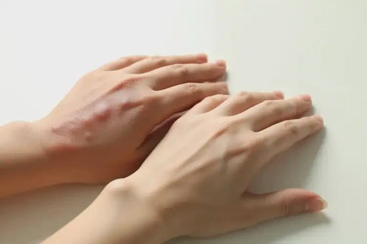 女人手上長濕疹可以治好嗎(圖4)