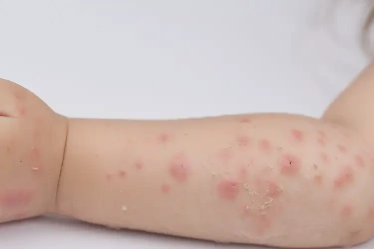 兒童手臂上起濕疹能徹底自愈嗎(圖4)