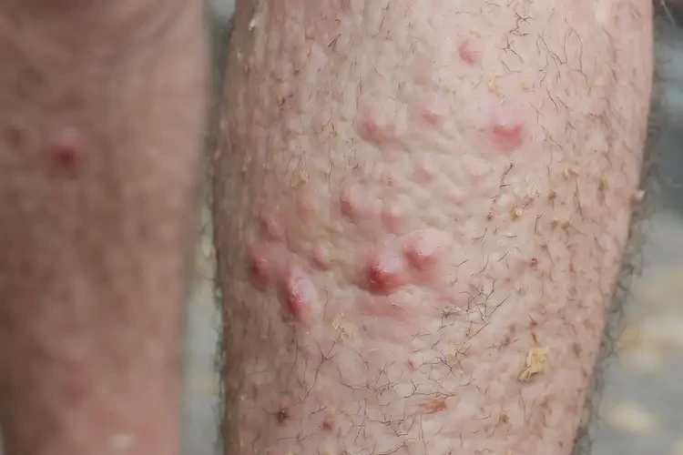 老年人小腿上偶爾長濕疹可以治好嗎(圖4)