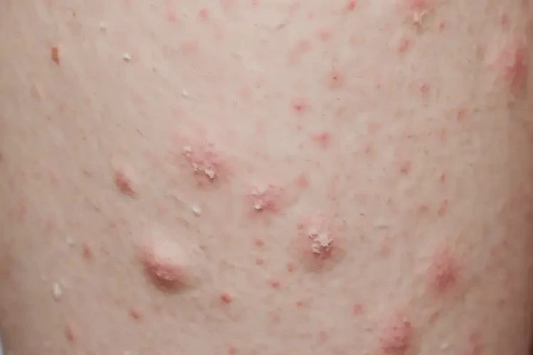 女性大腿上出現(xiàn)濕疹可以治好嗎(圖3)