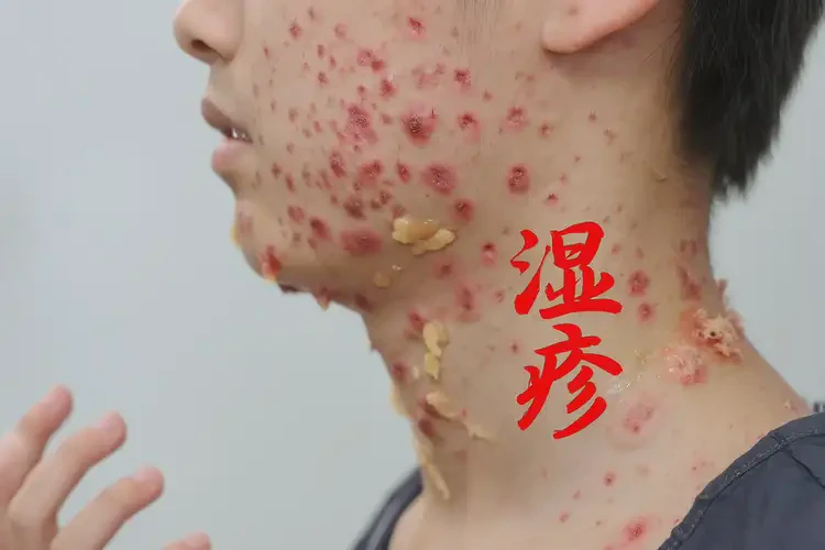 青少年脖子起湿疹可以治好吗(图4)