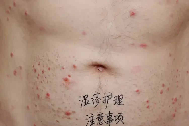 男性肚子上出湿疹可以彻底自愈吗(图4)