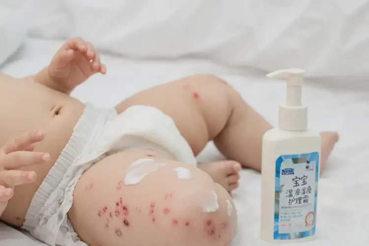 寶寶大腿起濕疹可以治好嗎(圖3)