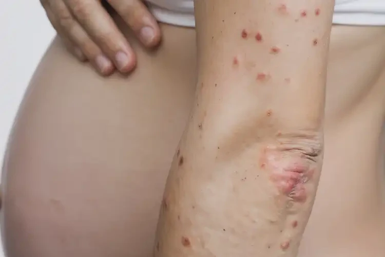 孕婦手臂上出現(xiàn)濕疹可以治好嗎(圖4)