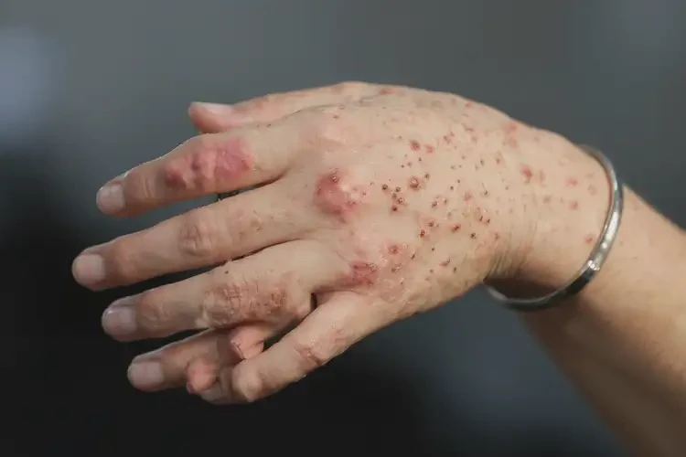 女性手上起濕疹可以治好嗎(圖4)