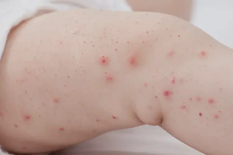 嬰兒大腿容易起濕疹能治好嗎(圖4)