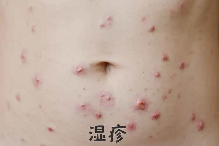 孩子肚子上出現(xiàn)濕疹能徹底自愈嗎(圖4)