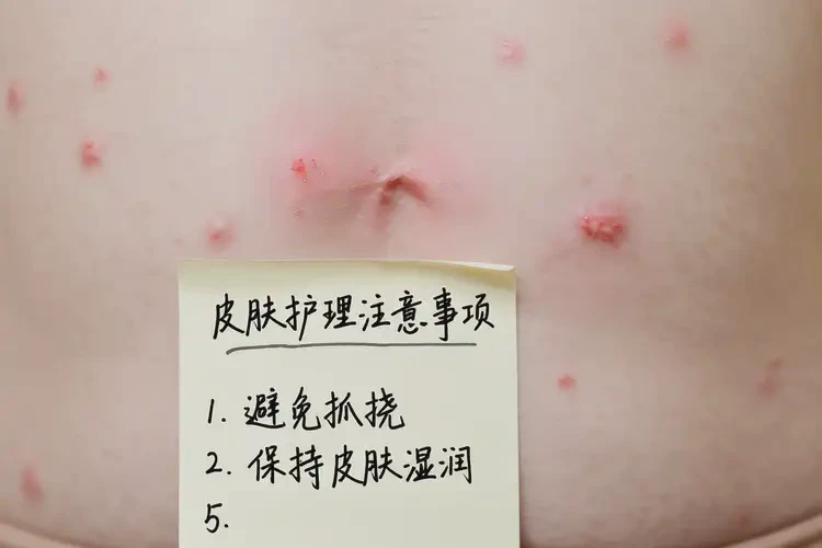 哺乳期媽媽屁股上偶爾起濕疹可不可以根治(圖4)