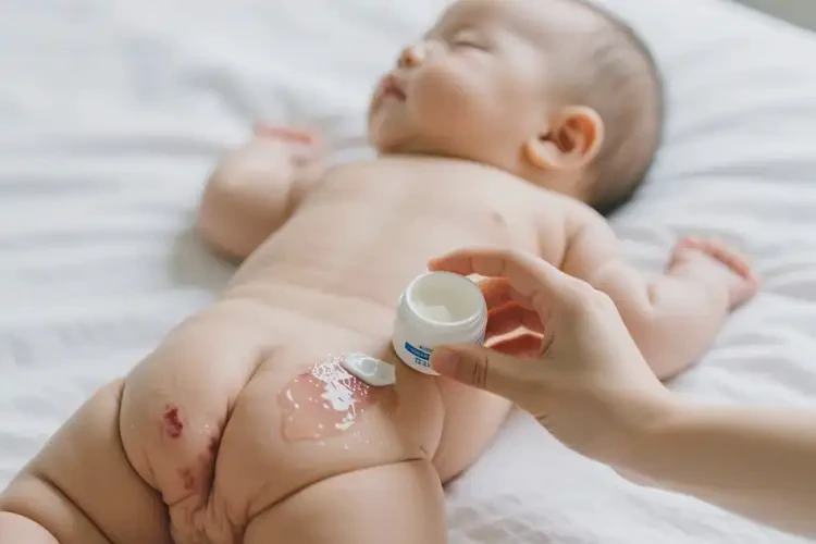 寶寶屁股上有濕疹可以治好嗎(圖2)