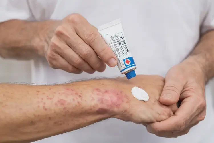 男人四肢經常起濕疹可以治好嗎(圖3)