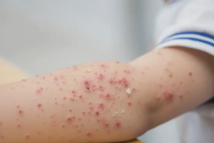 小學(xué)生手臂經(jīng)常長濕疹可以治好嗎(圖4)