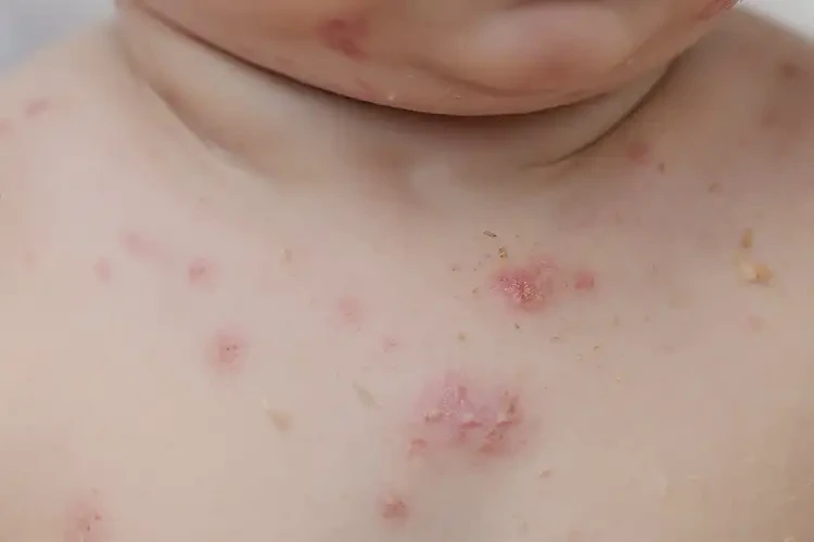 宝宝脖子长湿疹可以彻底自愈吗(图4)