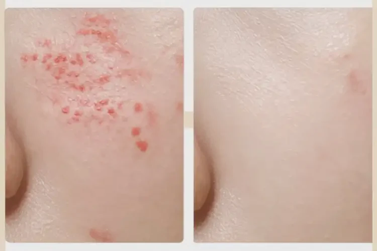 孕婦屁股上經(jīng)常長濕疹能徹底自愈嗎(圖2)