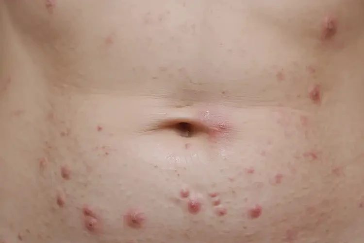 女人肚子有濕疹可不可以根治(圖4)