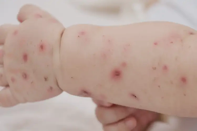 嬰兒四肢起濕疹可以治好嗎(圖3)