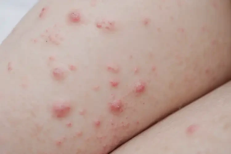 幼兒大腿上經(jīng)常起濕疹可以治好嗎(圖4)