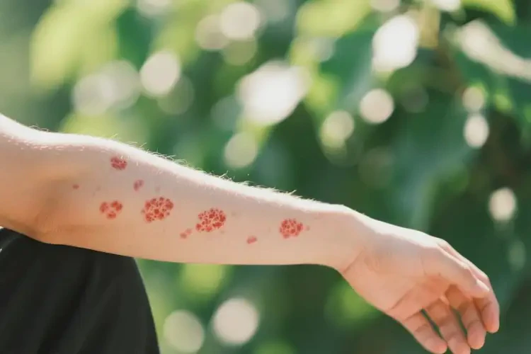 男生手臂上起濕疹可以治好嗎(圖4)