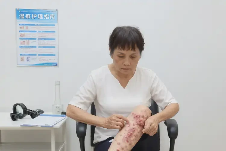 产妇小腿上长湿疹可以治好吗(图4)