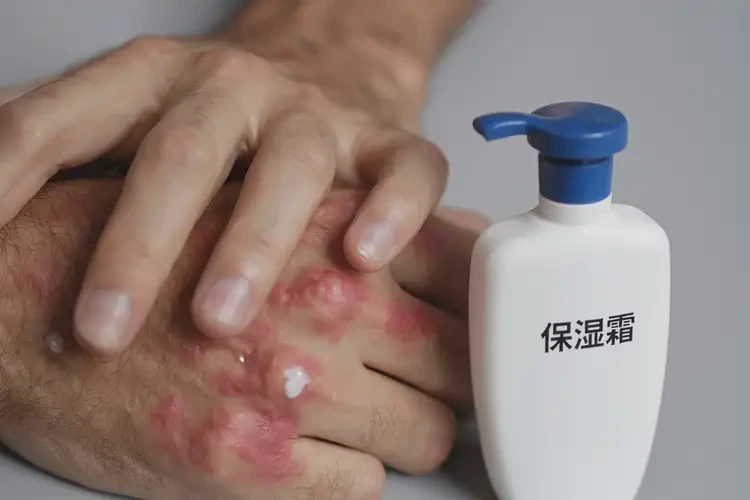 男生手上偶爾長濕疹可以治好嗎(圖4)