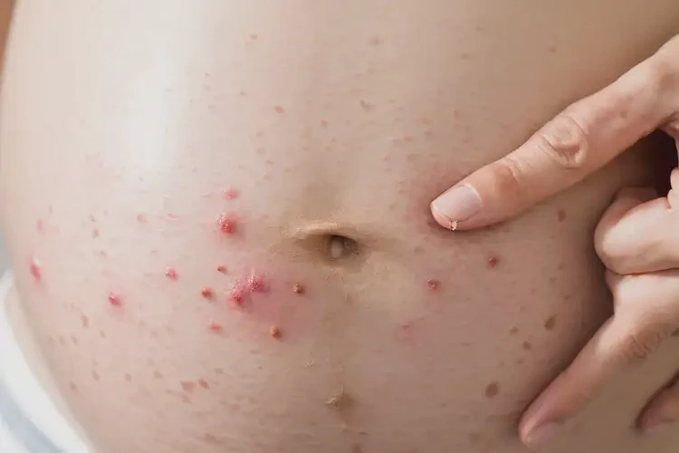 孕婦屁股上經(jīng)常長濕疹能徹底自愈嗎(圖4)