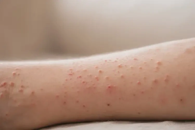 哺乳期媽媽手臂上偶爾起濕疹能徹底自愈嗎(圖3)