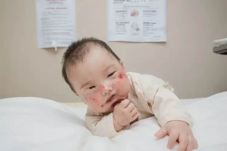 宝宝全身出现湿疹不管它会自己好吗(图4)