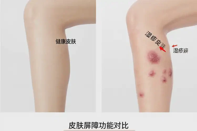 女性小腿上容易起濕疹可以治好嗎(圖1)