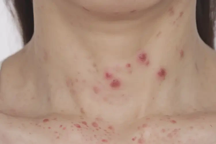 女生脖子上出濕疹可以治好嗎(圖4)