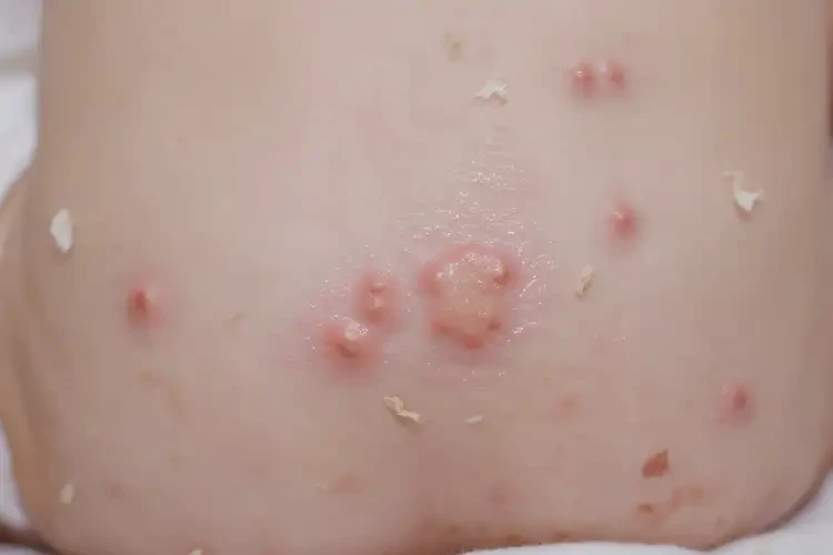 嬰兒屁股偶爾起濕疹可以治好嗎(圖4)