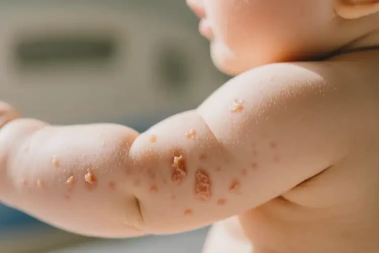 嬰幼兒手臂上有濕疹可以治好嗎(圖4)