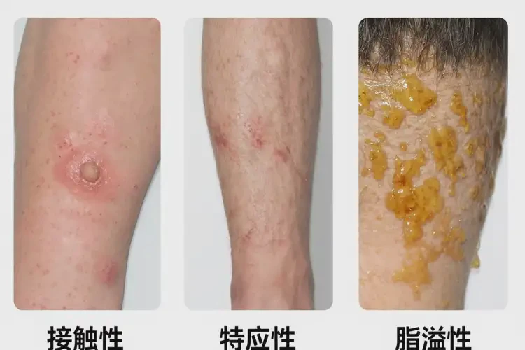 男人小腿容易長濕疹可以徹底自愈嗎(圖3)