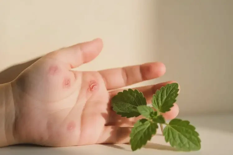 小兒手上出現(xiàn)濕疹可以治好嗎(圖4)