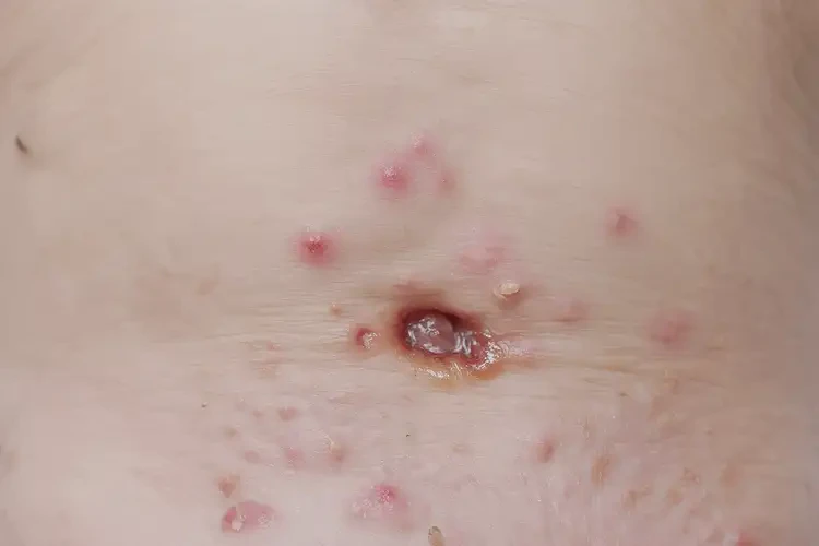 嬰幼兒肛周偶爾起濕疹能治好嗎(圖4)