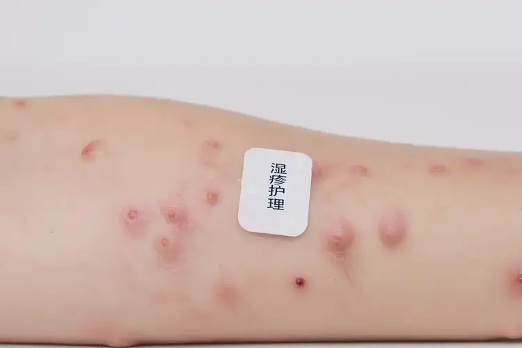 小學(xué)生手臂上出濕疹可以治好嗎(圖4)