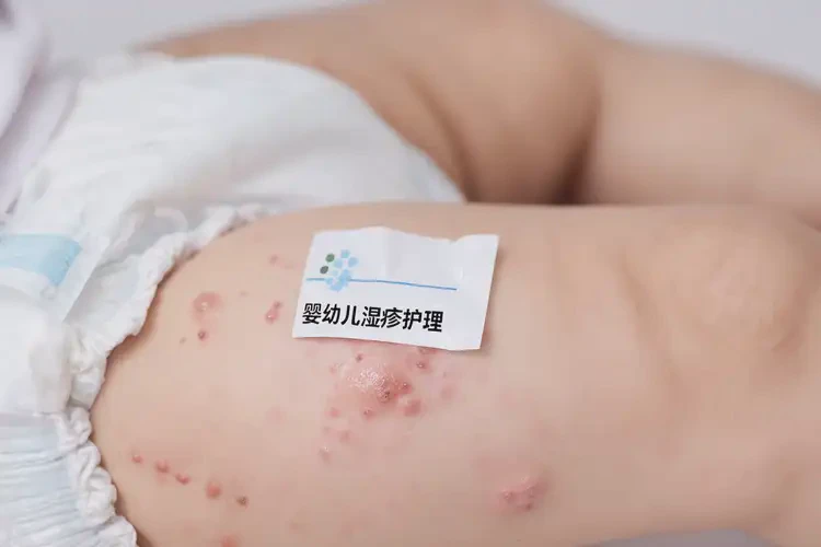 婴幼儿大腿经常长湿疹不管它会自己自愈吗(图4)