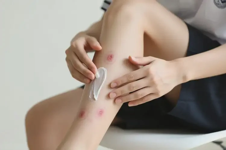 大學(xué)生小腿上長濕疹可以治好嗎(圖4)