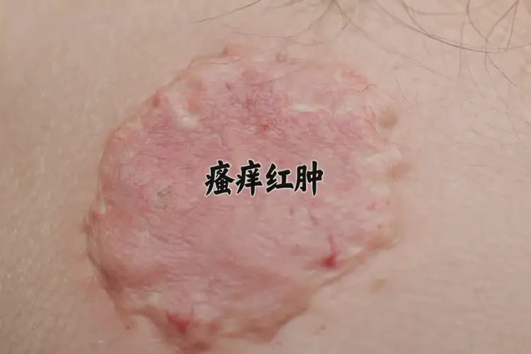 女生肛周長(zhǎng)濕疹可以治好嗎(圖4)