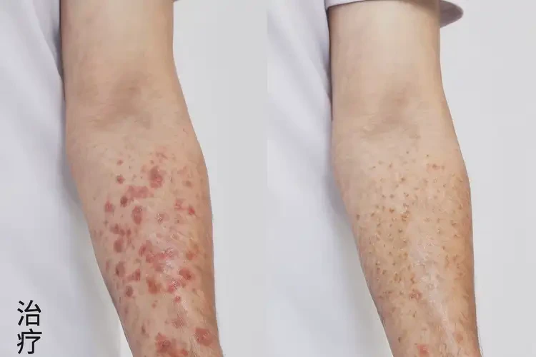 男性屁股上長濕疹可以治好嗎(圖1)