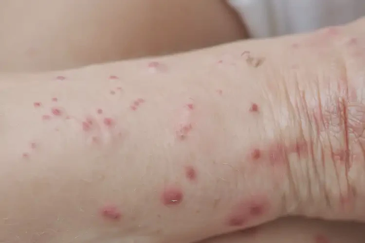 女性四肢出现湿疹可以治好吗(图4)