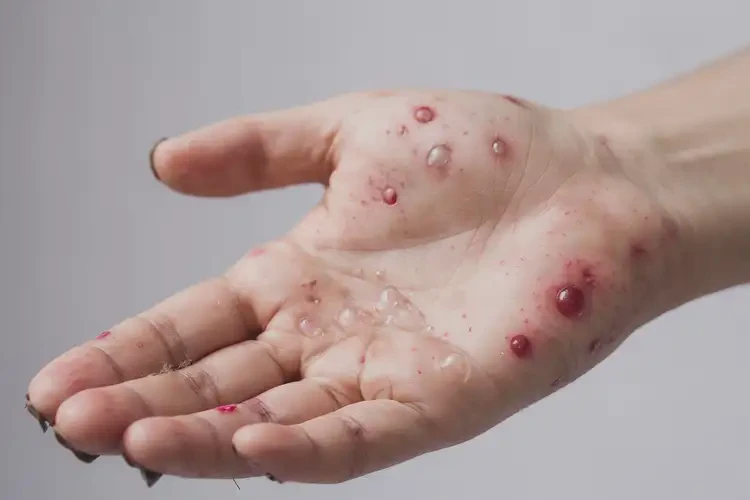 青少年全身起濕疹能徹底自愈嗎(圖3)