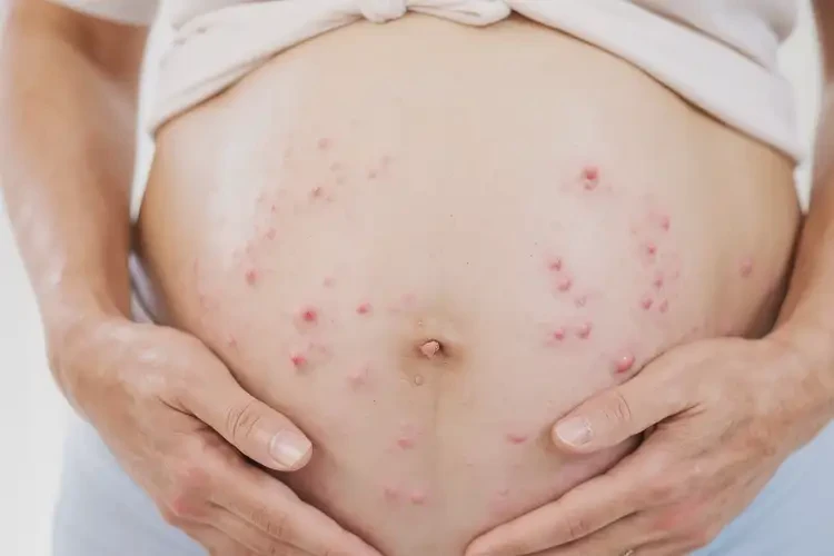 哺乳期媽媽肚子偶爾長濕疹可不可以根治(圖4)