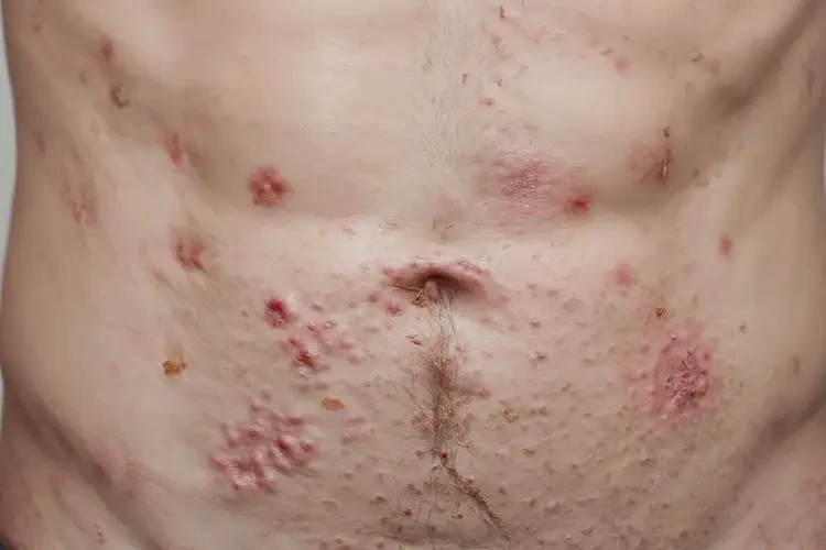 男人肚子上出現(xiàn)濕疹可不可以根治(圖4)