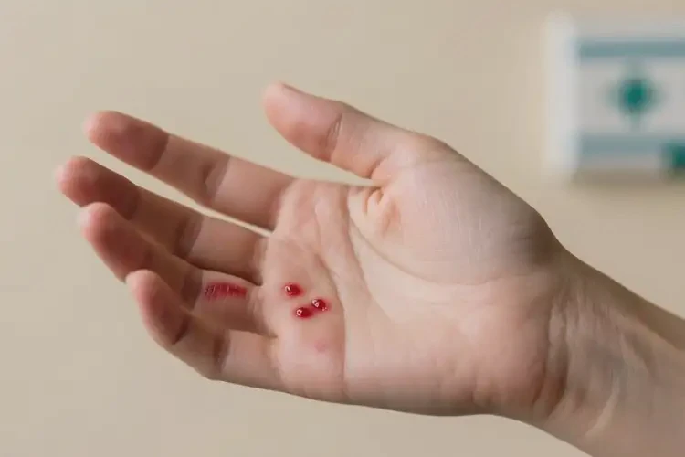 女人手上起濕疹可不可以根治(圖4)