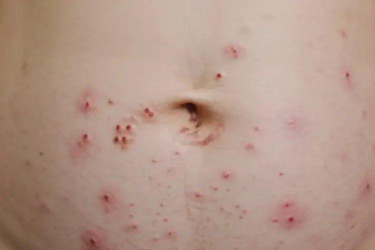 產(chǎn)婦肚子上起濕疹可以治好嗎(圖4)